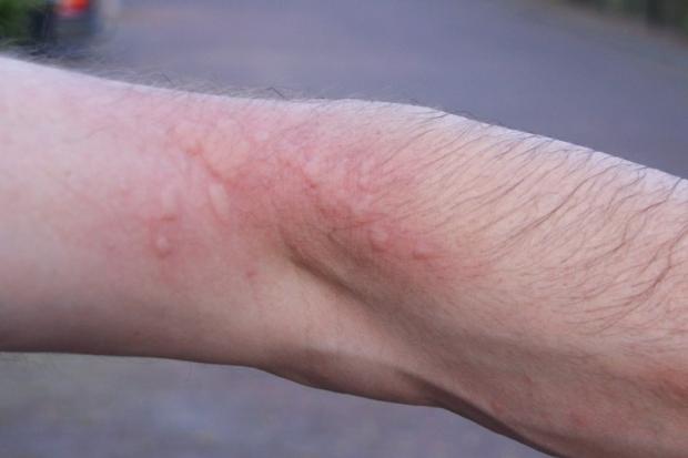 A rash caused by oak processionary moth hairs (with permission of the Oak Processionary Moth Project, Forestry Commission)